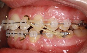 3M Clarity Advanced Braces and TADs in treatment 