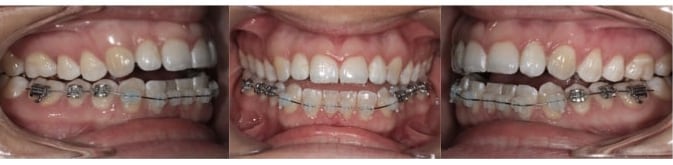 Increased open bite after alignment