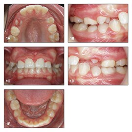 Intraoral images of the initial situation with labially displaced unerupted maxillary canines
