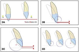 Lingual bracket slots relative to the tooth's center of resistance.