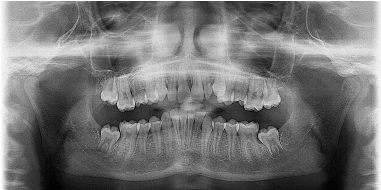 Pellerin Case initial Xray
