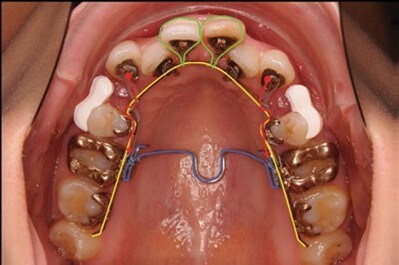 Recommended method of canine retraction