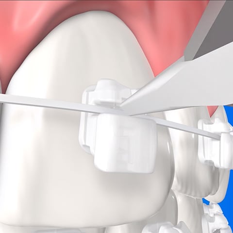 Removing bracket