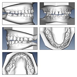 Figures 1J-N: Malocclusion models supprimer