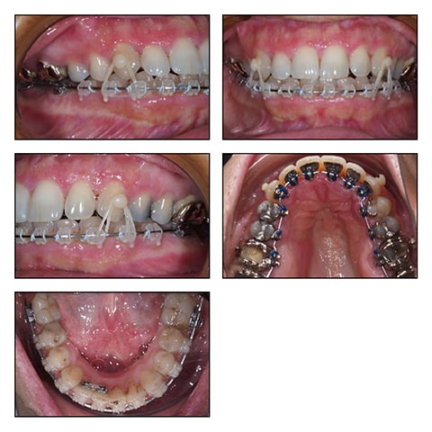 Figures 3A&rsquo;-T&rsquo;: Intraoral photos with 0182x0182 B3T