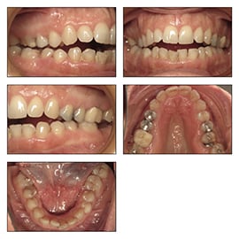 Figures 1E-I: Intraoral photos