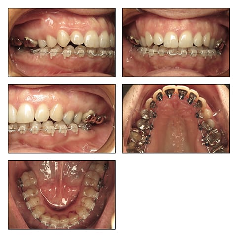 Figures 2K&rsquo;-O&rsquo;: Intraoral photos with 018x025 NITI