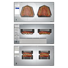 Treatment planning and virtual bracket placement with the 3Shape OrthoAnalyzer software