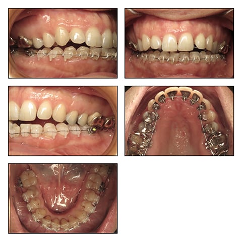 Figures 2F&rsquo;-J&rsquo;: Intraoral photos with 016x022 NITI