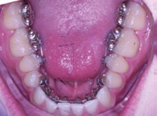 0.014 NiTi wires engaged into the upper and lower arches of teeth