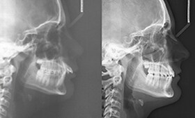 Cephalometric x-rays pre- and post-treatment of a case using brackets and the Forsus device