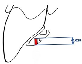 Vertical archwire dimension .025
