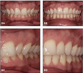 Treatment of deep bite with retroclined incisors