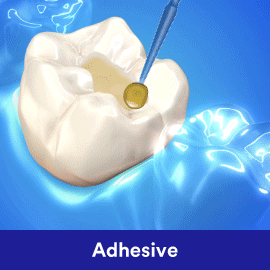 clinpro dental varnish for an effective caries prevention process