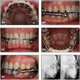 No significant changes of the lower incisors inclination