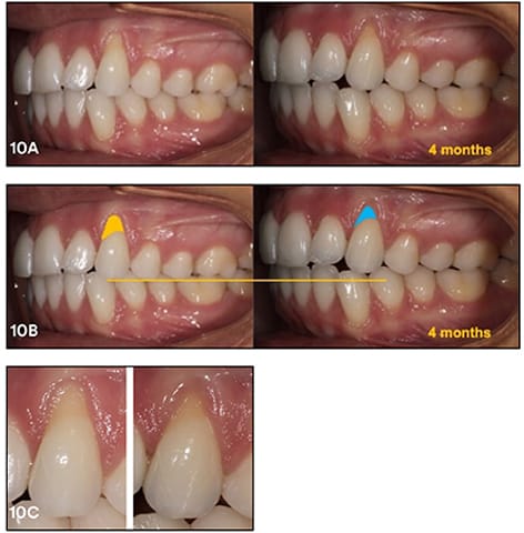 Improvement of the gingival retraction after 4 months of treatment with extra palatal rot torque predefinition in torque active Incognito arches