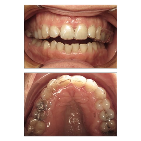 Figures 1F&rsquo;-G&rsquo;: Maxillary retainer
