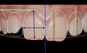 A Digital Smile Design with the 3M™ Clarity™ ADVANCED Ceramic brackets: A perfect synergy