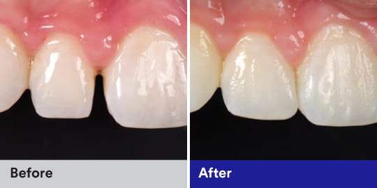 diastema closure case study with filtek Z350XT composite. 
