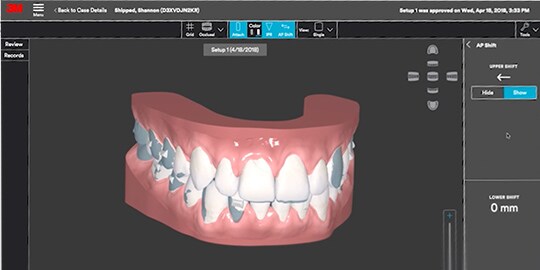 Video showing how the open web-based platform can enable individualised patient treatment options for clear dental aligners and teeth alignment trays.
