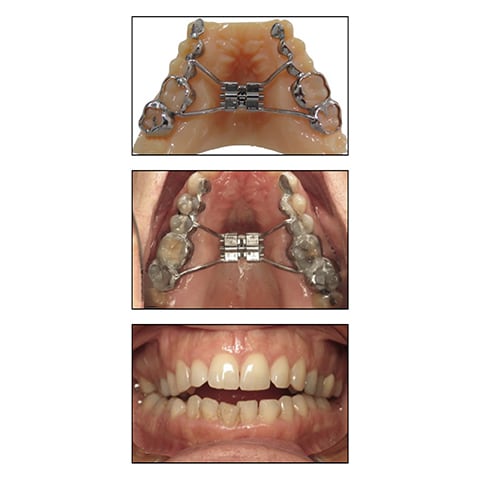 Before surgical assisted disjunction
