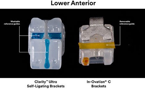Clarity Ultra Self-Ligating Bracket versus In-Ovation C Brackets Washable Reference Guide versus Removable Reference Guide