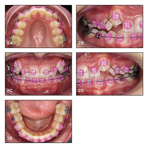 Situation after bracket bonding, application of the first archwire set and ligation