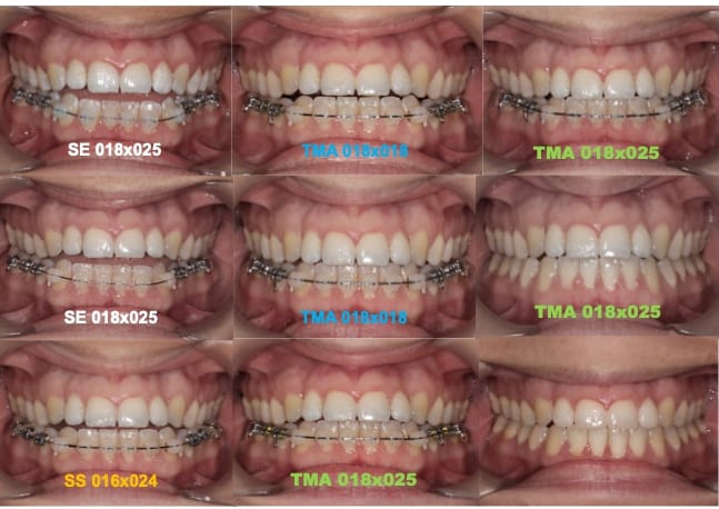 Torque active arches decreasing open bite