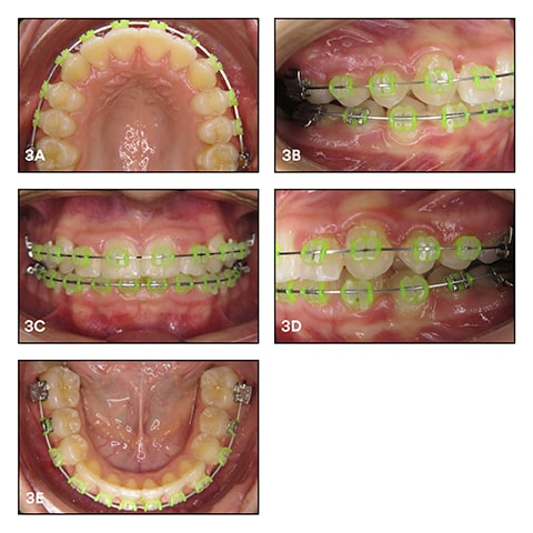 Levelling phase with rectangular heat-activated archwires (0.017 x 0.025" NiTi HA) in place