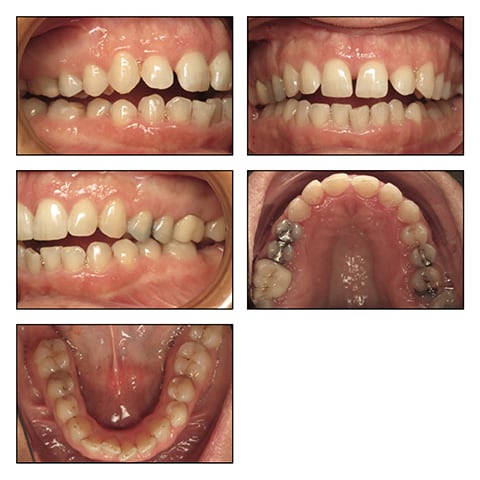 Figures 2A-E: Phase II intraoral photos