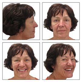 Figures 1A-D: Extraoral photos